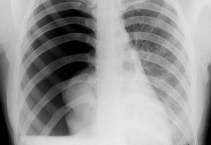 Tràn khí màn phổi là một bệnh lý liên quan đến cơ quan hô hấp